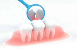 前歯部のインプラント