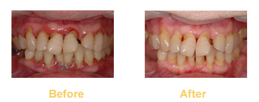 歯周病治療の前と後