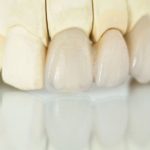 歯の表面が白い？～エナメル質形成不全症って？～